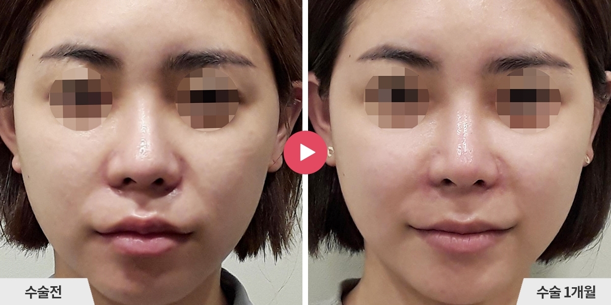 자가늑코재수술+비순각교정+콧볼축소+귀족수술+비중격만곡증교정