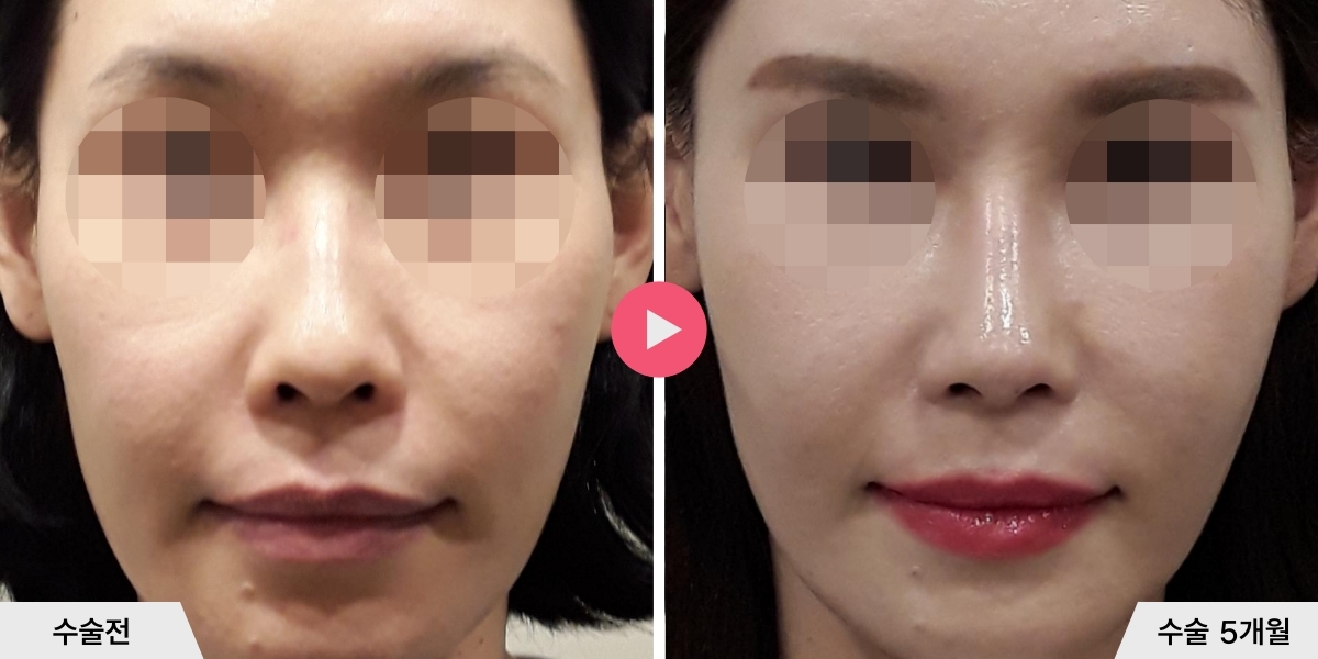 매부리코성형+진피이식