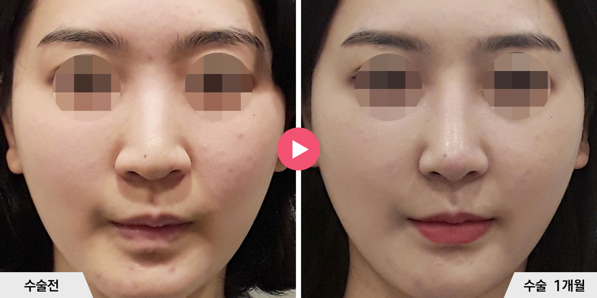 코성형+비순각교정+진피이식+콧볼축소+귀족수술