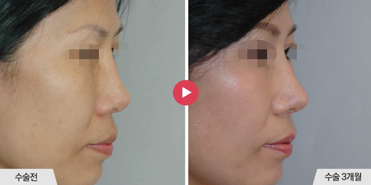 콧등의 폭이 좁은 경우