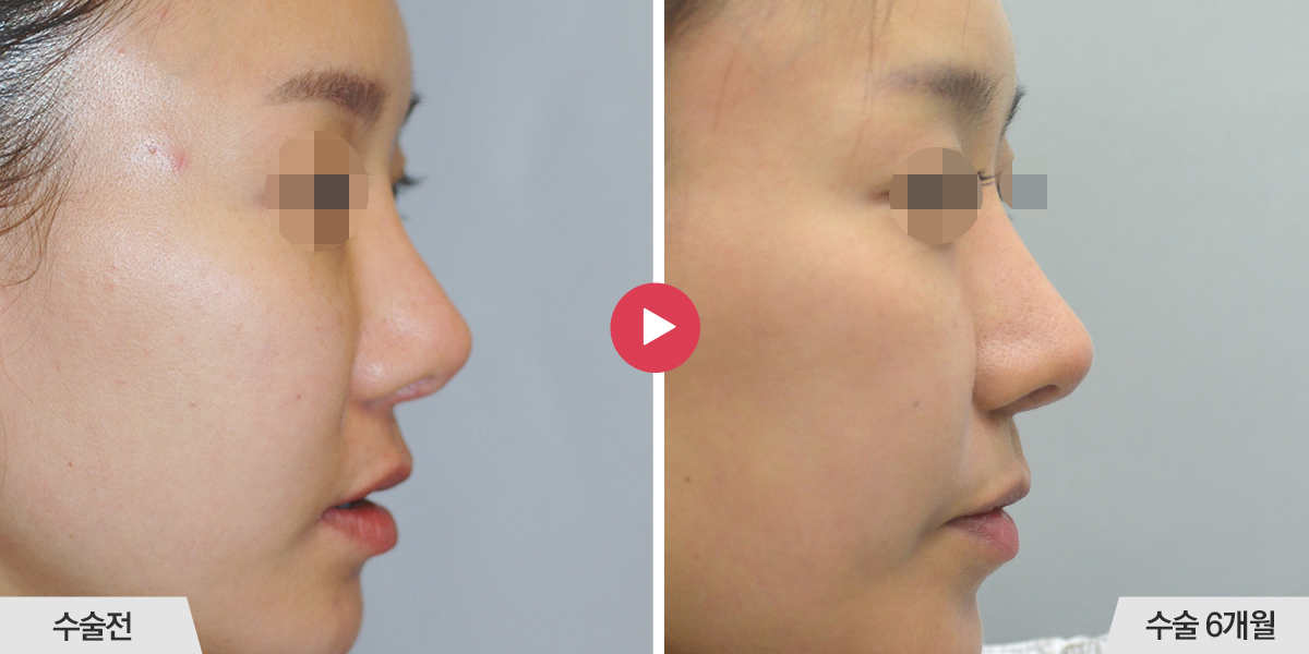 콧등이 넓거나 비대칭인 경우