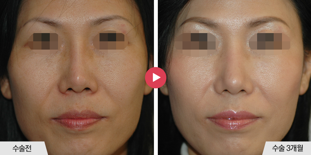 콧등의 폭이 좁은 경우