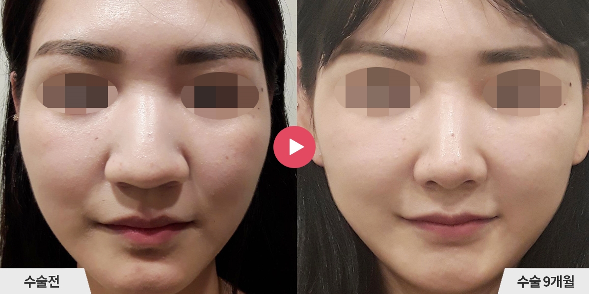 복코성형+비순각교정+콧볼축소+귀족수술