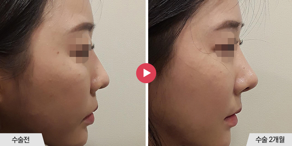 코재수술+절골+진피이식