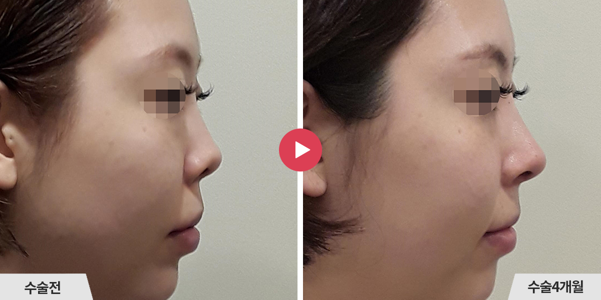 코재수술+비공내리기+진피이식