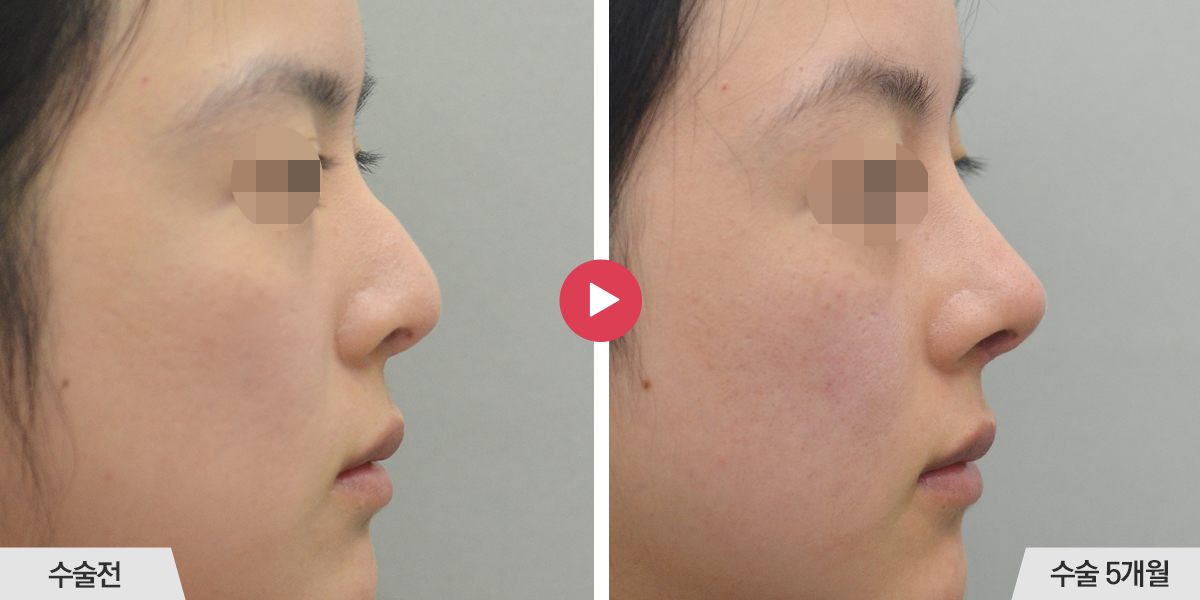 콧등이 매끄럽지 않거나 코끝과의 경계가 표시나는 경우