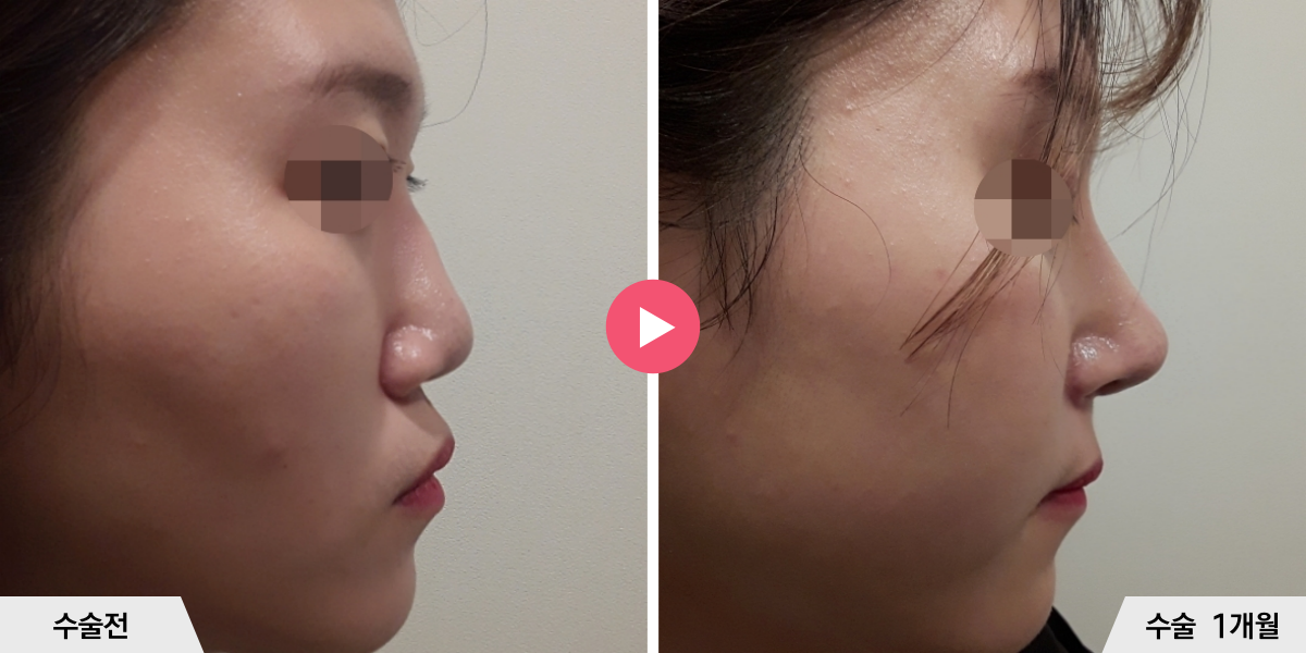 복코성형+매부리교정+비순각교정+콧볼축소+귀족수술