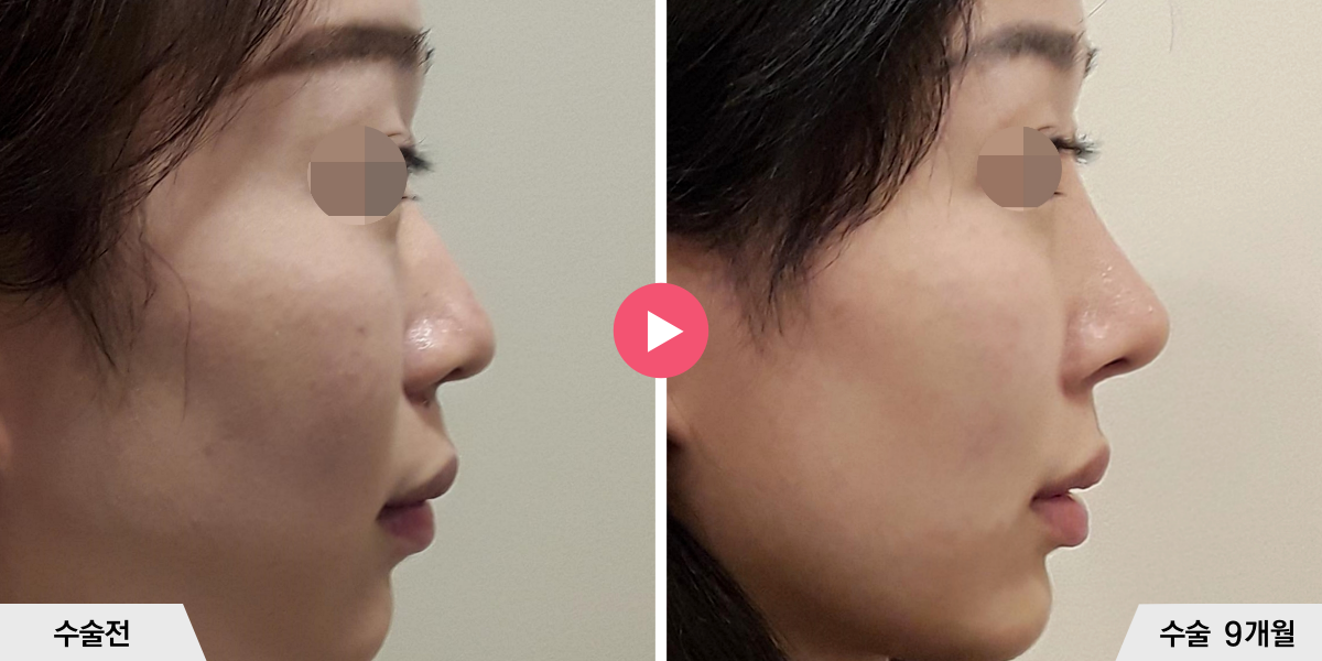 자가늑코성형+비순각교정+콧볼축소+귀족수술+비중격만곡증교정