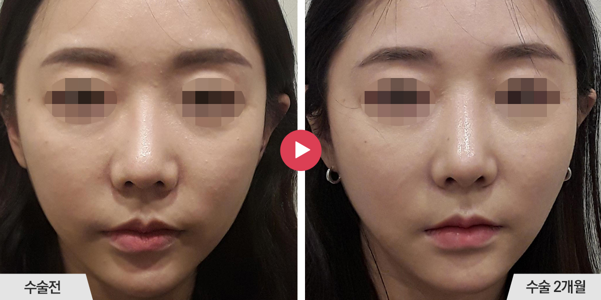 코재수술+절골+진피이식