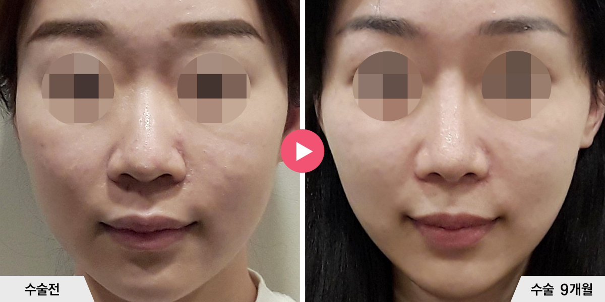 자가늑코성형+비순각교정+콧볼축소+귀족수술+비중격만곡증교정