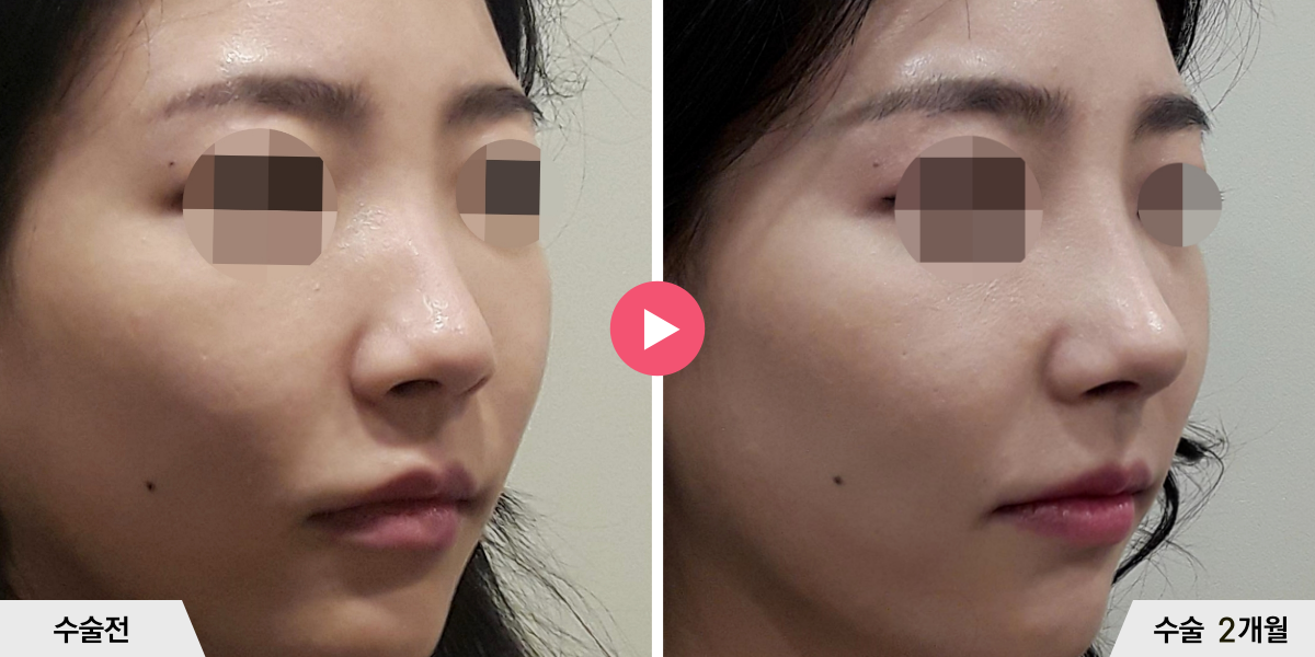 코성형+절골+비중격만곡증교정