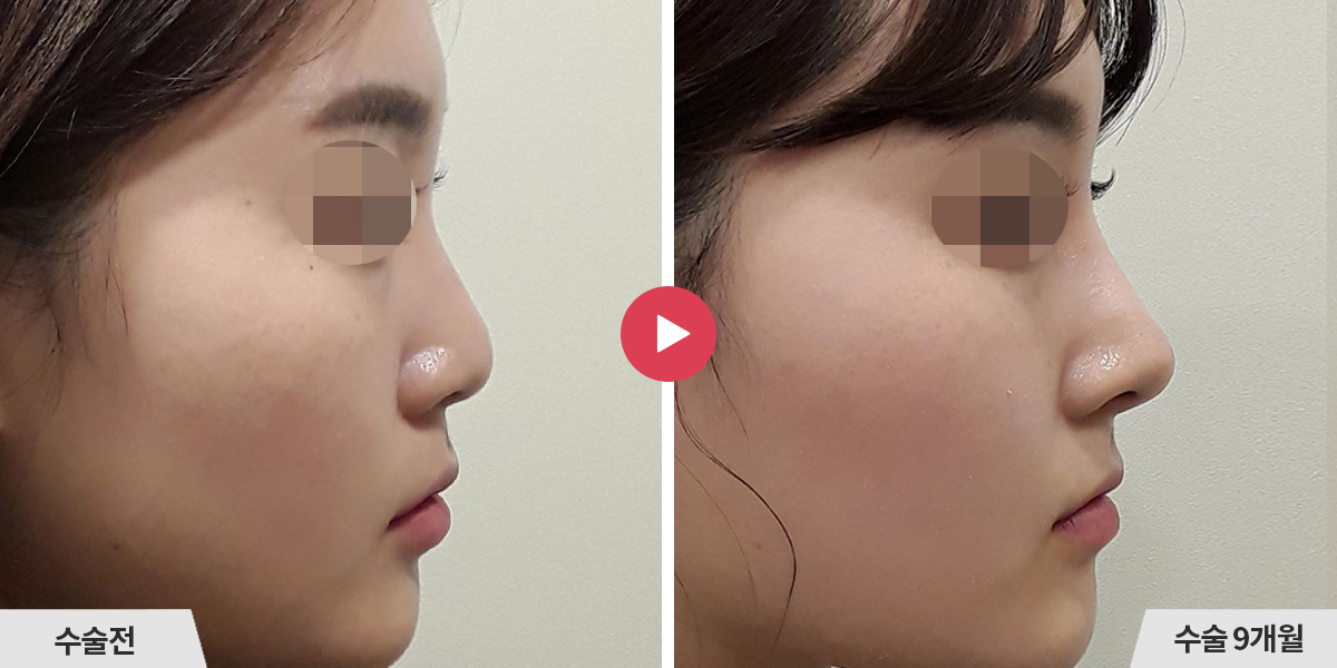 코성형+절골+비순각교정+진피이식