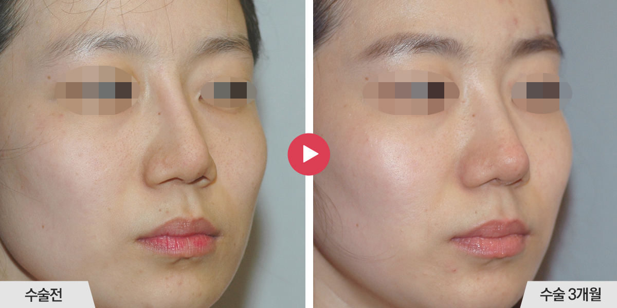 콧등의 폭이 좁은 경우