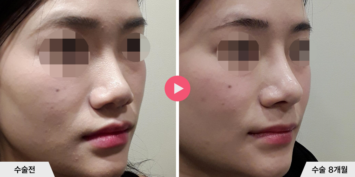 코성형+비순각교정+비공내리기+진피이식