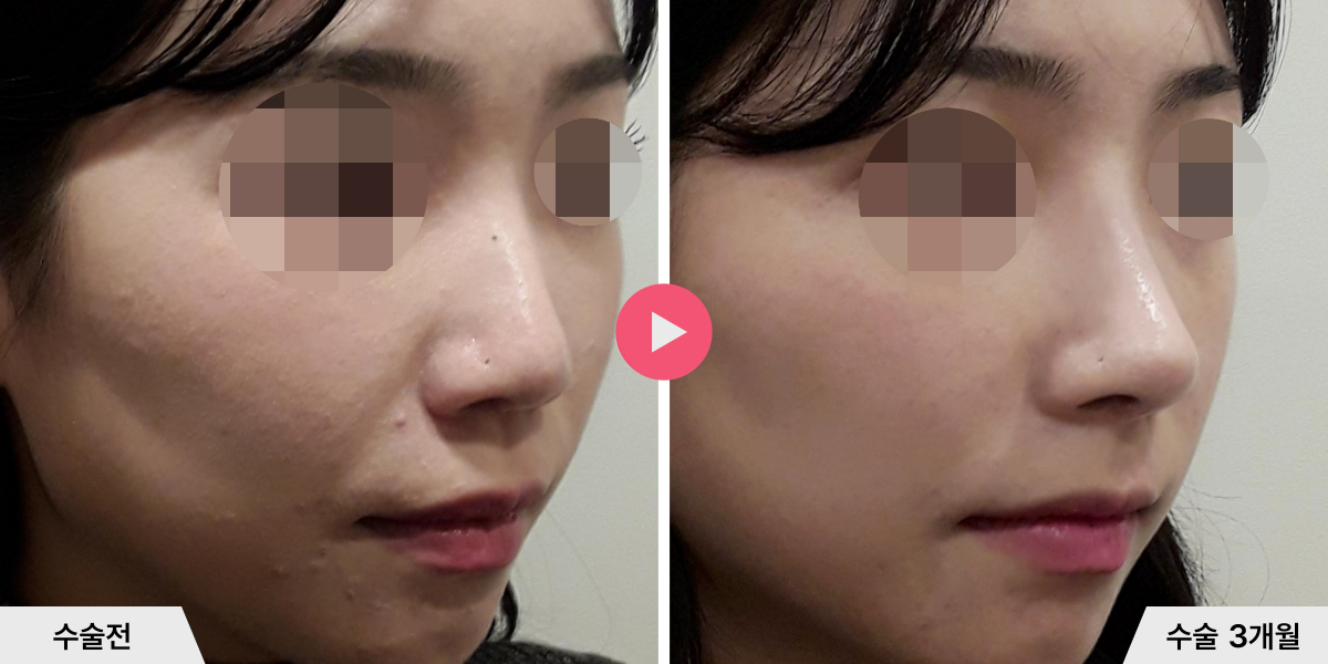 코성형+절골+비순각교정