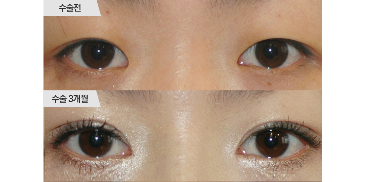 쌍꺼풀 수술, 매몰법 & 앞트임 수술