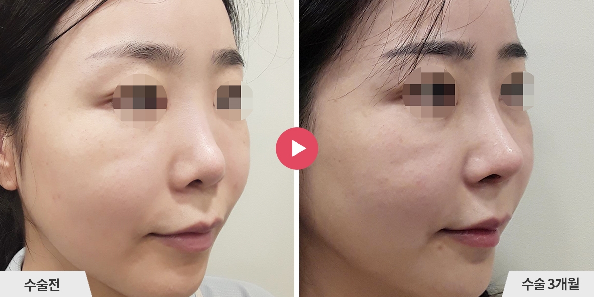 자가늑코재수술+비순각교정+진피이식+귀족수술