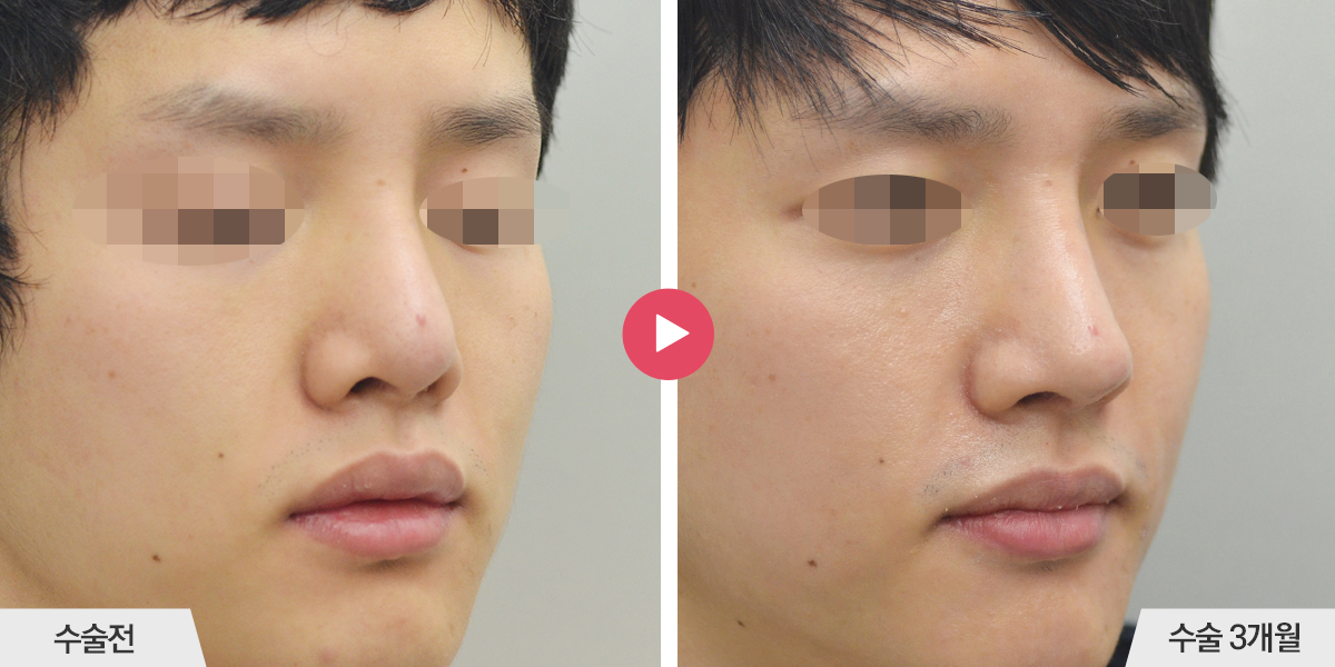 콧등이 넓거나 비대칭인 경우