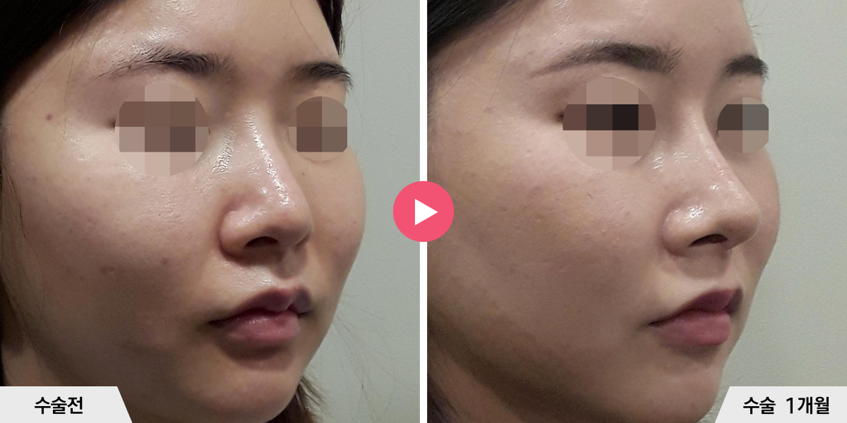 코성형+비순각교정+진피이식