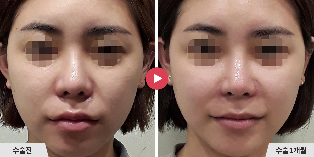 자가늑코재수술+콧볼축소+귀족수술