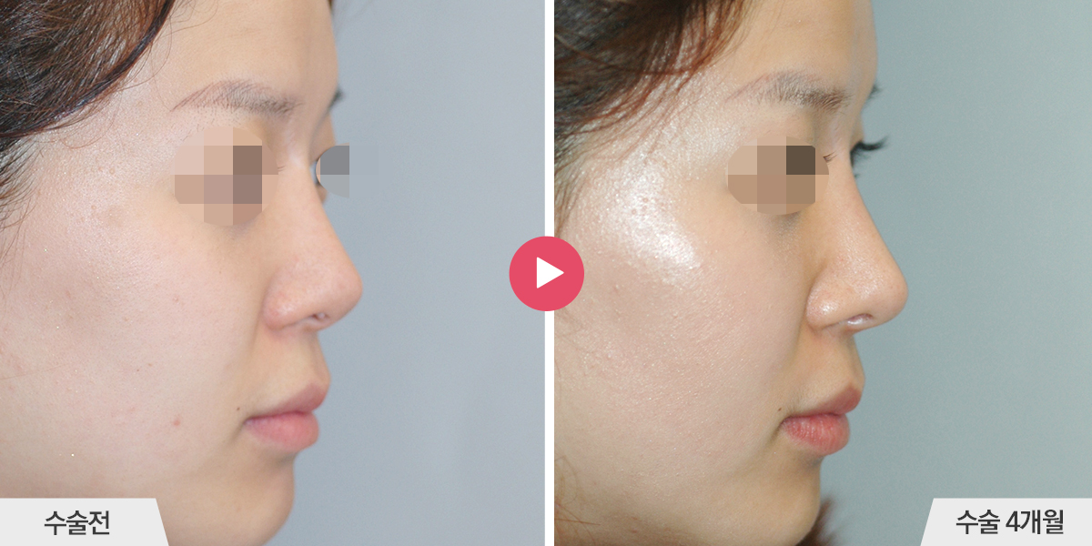 보형물이 삐뚤어진 경우