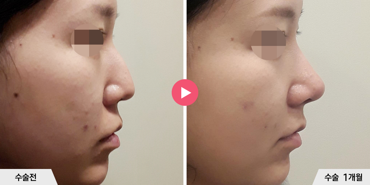 코끝성형+비순각교정+귀족수술