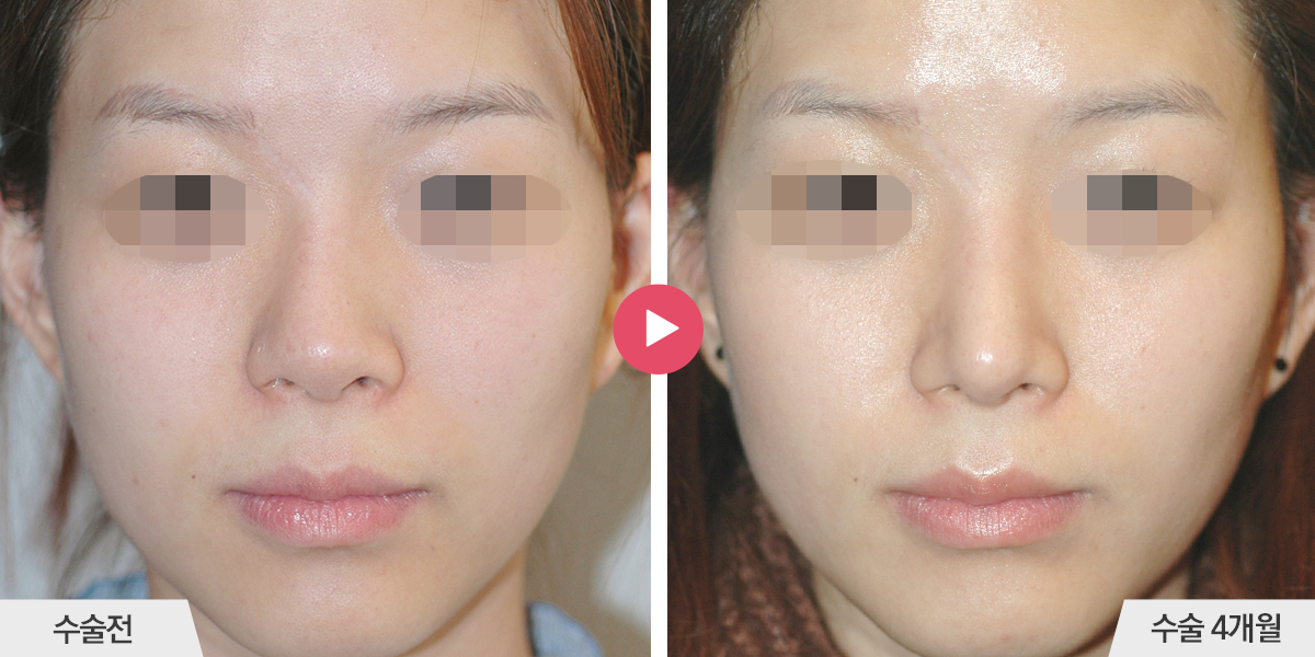 보형물이 삐뚤어진 경우