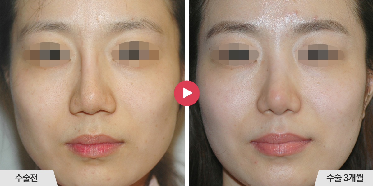 콧등의 폭이 좁은 경우