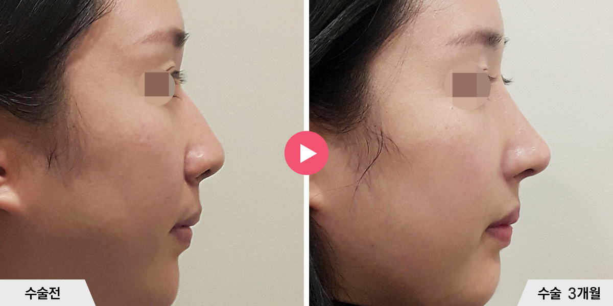 코성형+절골+콧볼축소+귀족수술+비중격만곡증교정