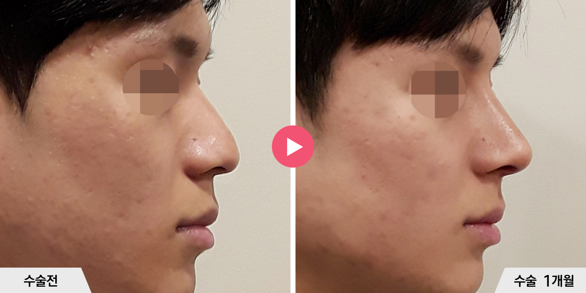 매부리코성형+절골+진피이식+비중격만곡증교정