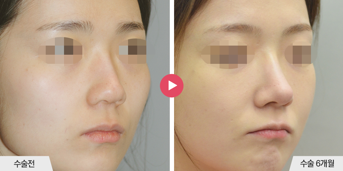 콧등이 넓거나 비대칭인 경우