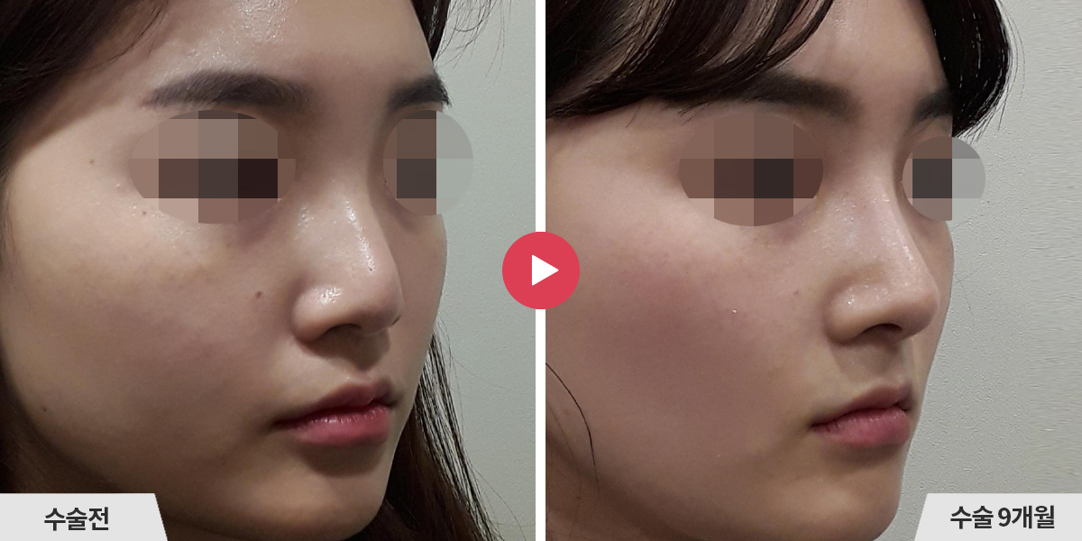 코성형+절골+비순각교정+진피이식