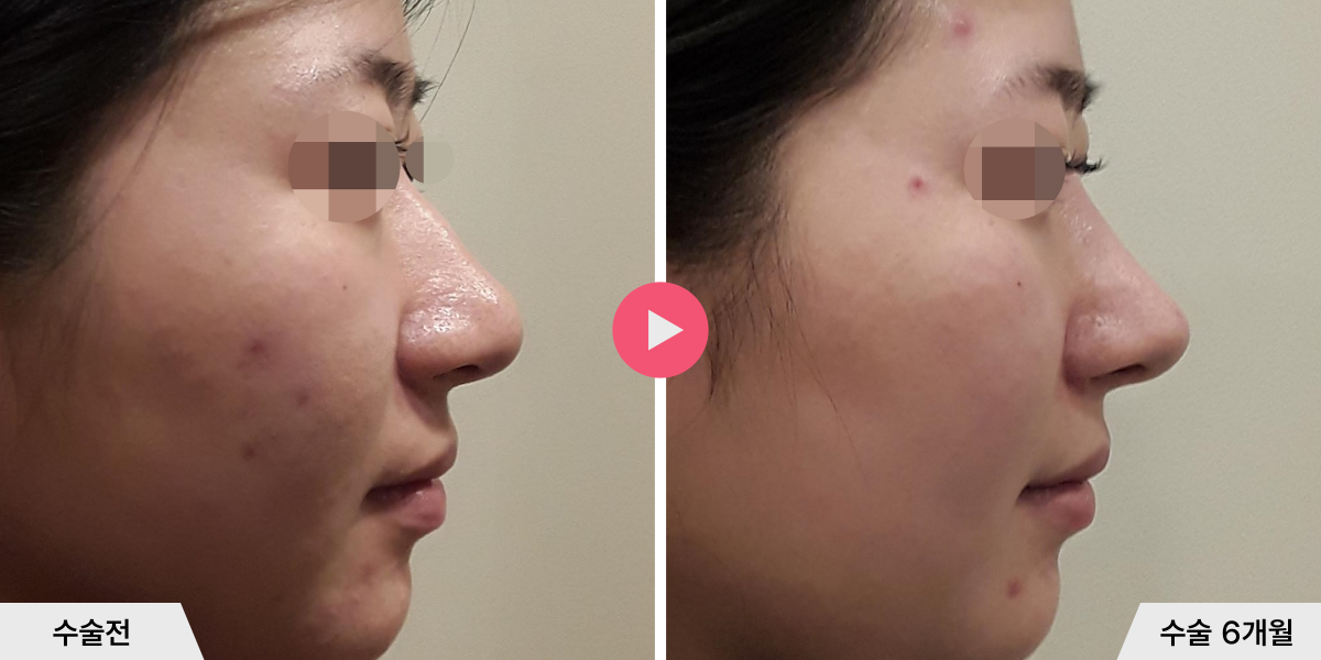 복코성형+절골+콧볼축소