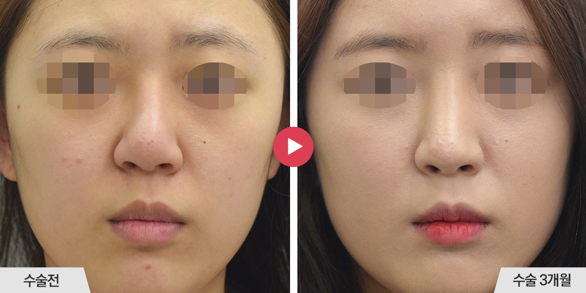 코끝이 뭉툭한 경우(복코 재수술)