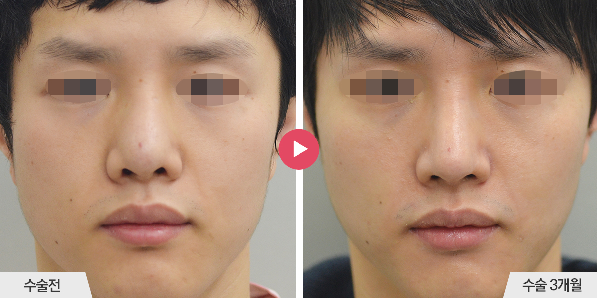 콧등이 넓거나 비대칭인 경우