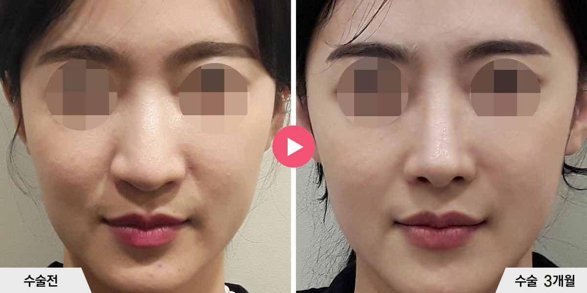 코성형+절골+비순각교정