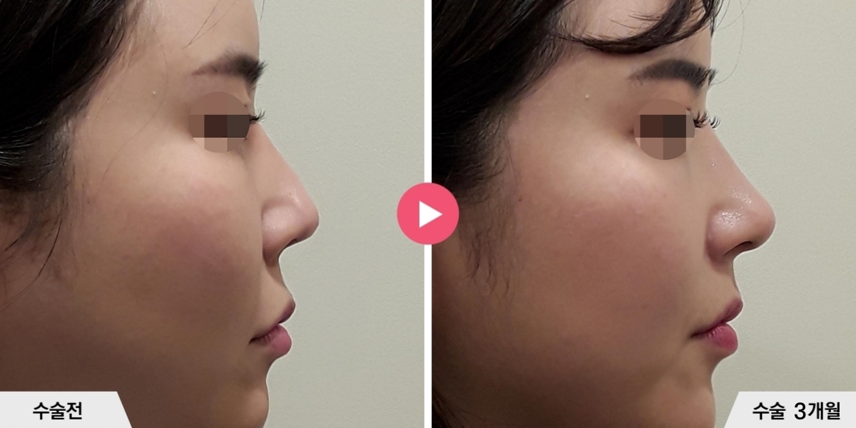 자가늑코재수술+절골+비공내리기+진피이식