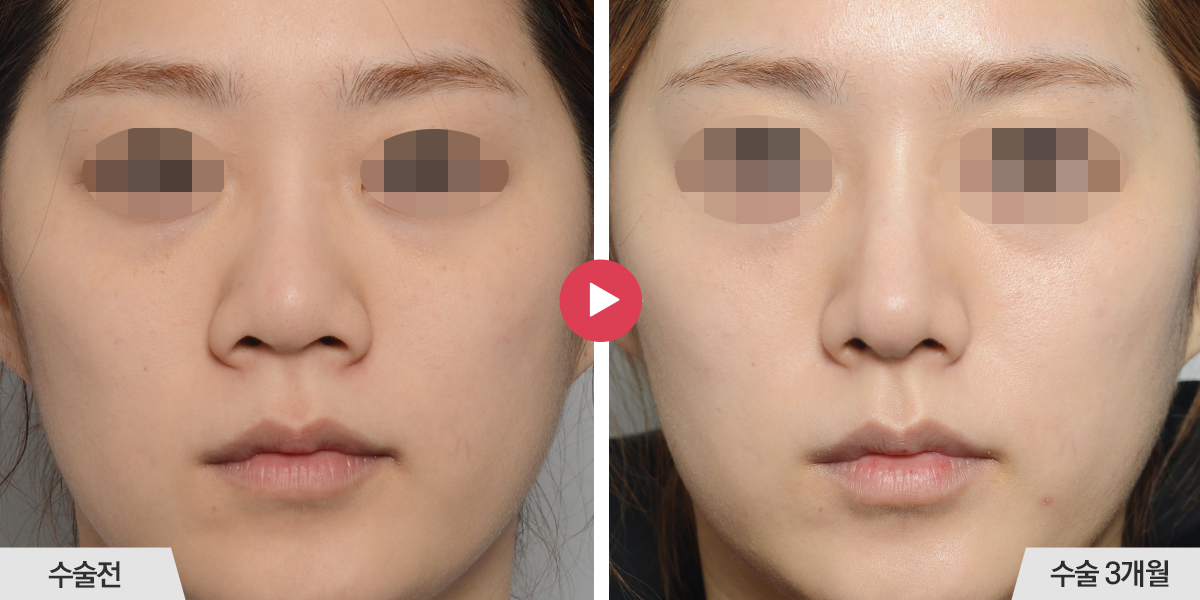 코끝이 뭉툭한 경우(복코 재수술)
