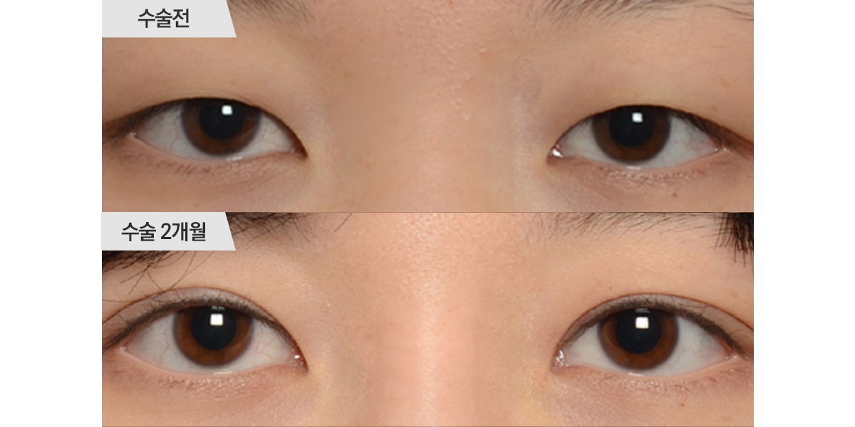 쌍꺼풀 수술, 절개법 & 앞트임 수술