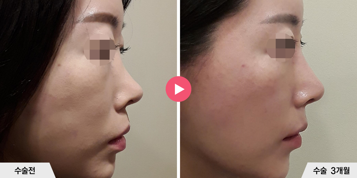 자가늑코재수술+절골+비순각교정+비공내리기+진피이식