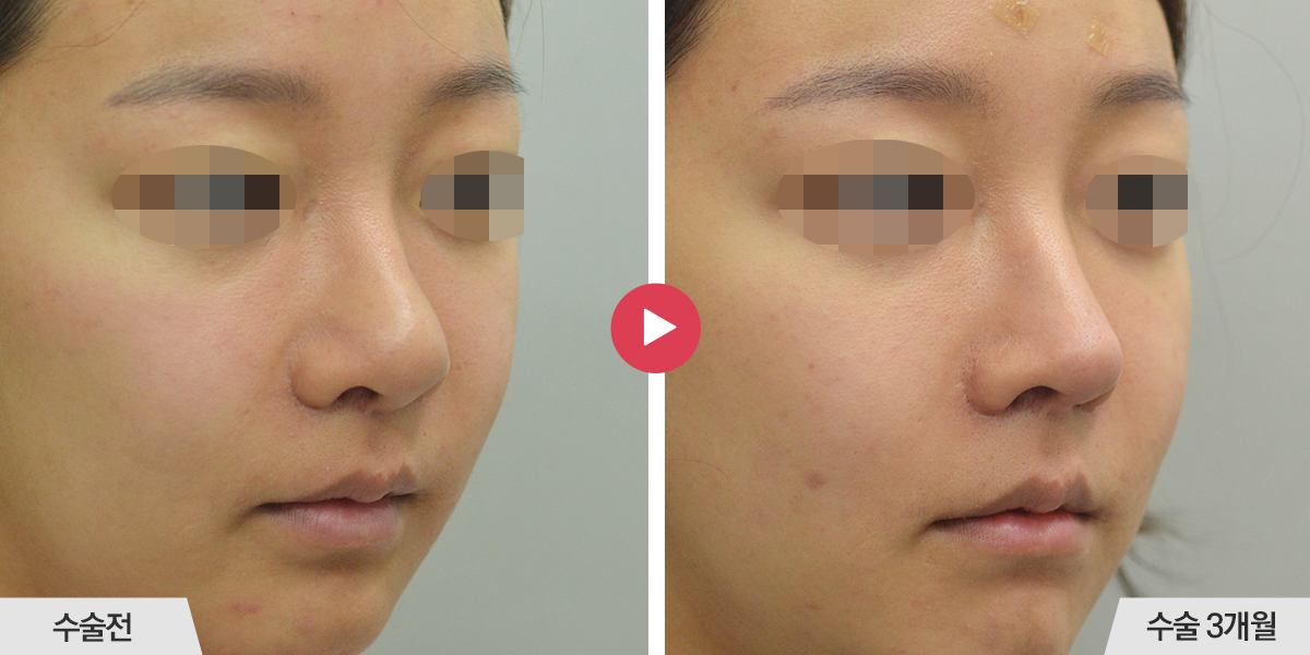 코끝이 뭉툭한 경우(복코 재수술)