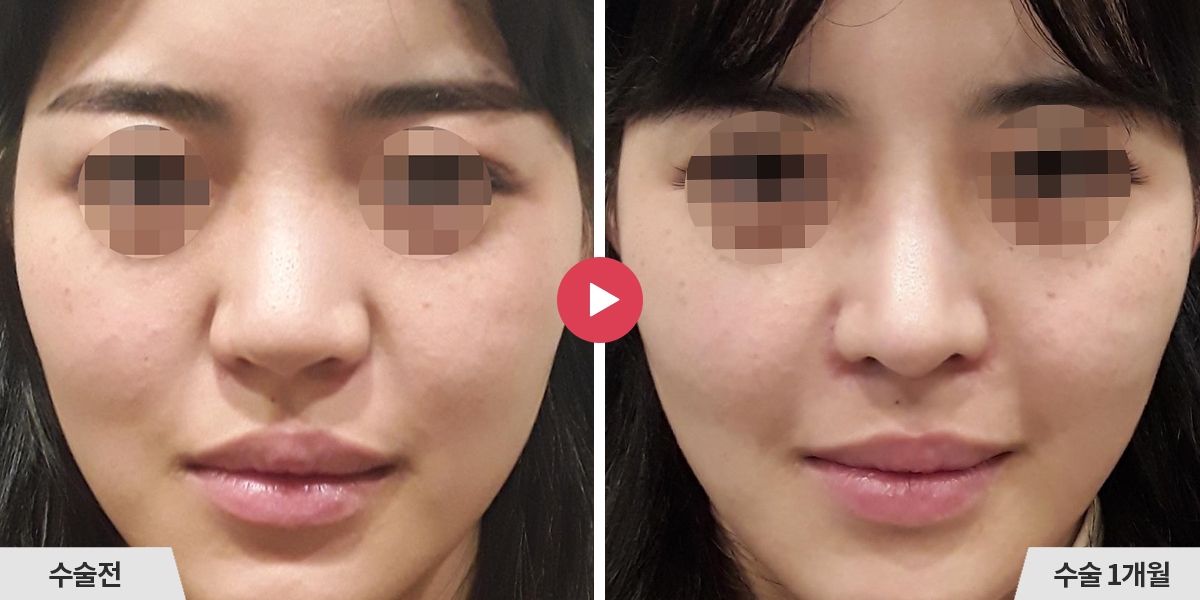 코재수술+비순각교정+콧볼축소+귀족수술