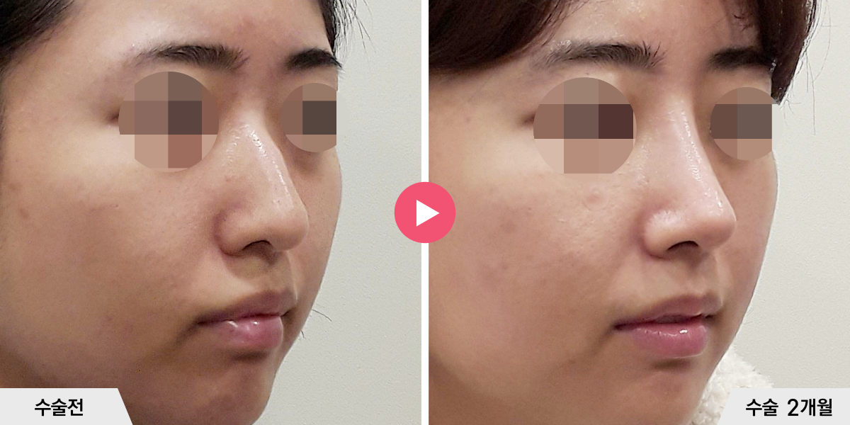 매부리코성형+절골+비중격만곡증교정