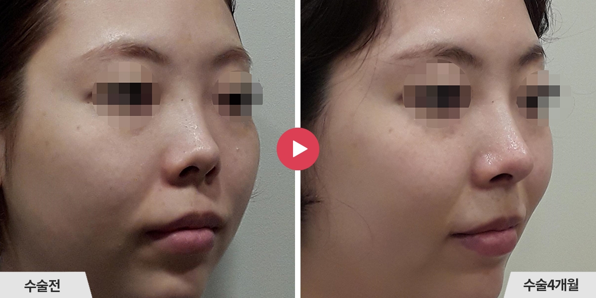 코재수술+비공내리기+진피이식