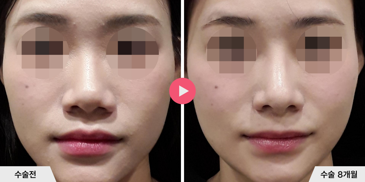 코성형+비순각교정+비공내리기+진피이식