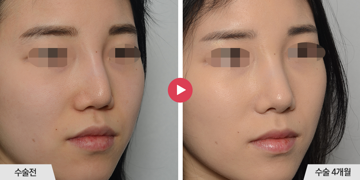 콧등이 너무 높은 경우