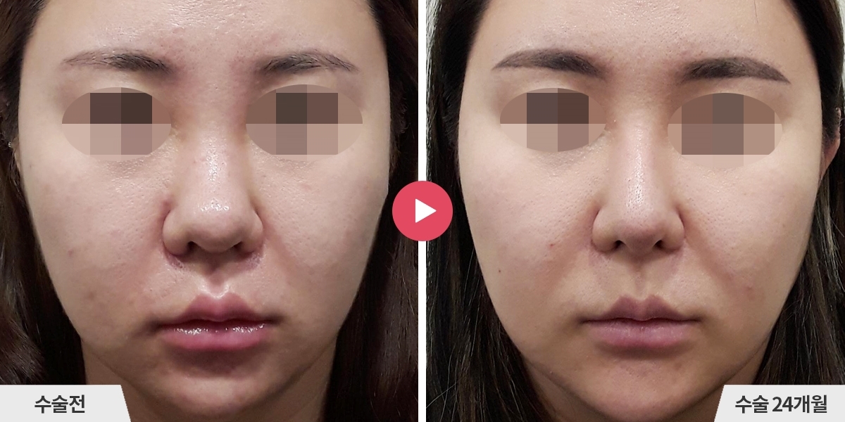 복코성형+비순각교정+콧볼축소+귀족수술