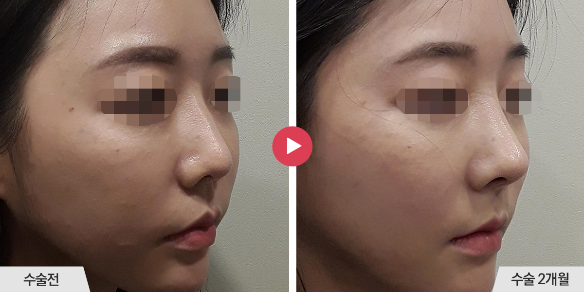 코재수술+절골+진피이식