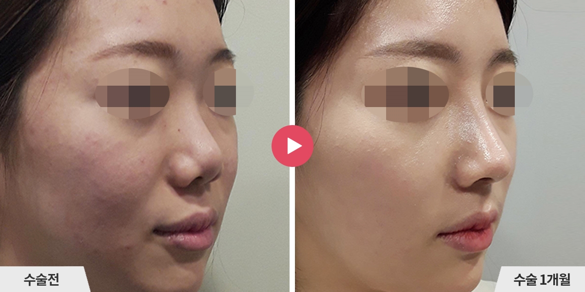 코성형+비순각교정+콧볼축소+귀족수술