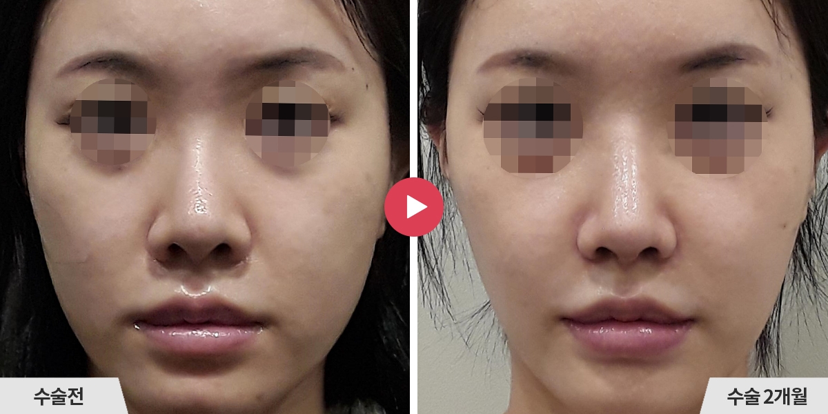 코재수술+비공내리기+비순각교정+콧볼축소+귀족수술